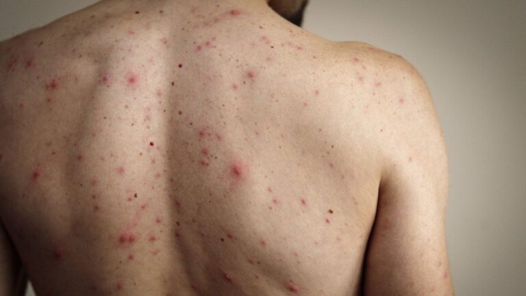 España dejó de estar libre de sarampión, según indicó la OMS