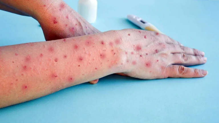 Detectan el primer caso de viruela del mono más severa en Argentina: síntomas y prevención